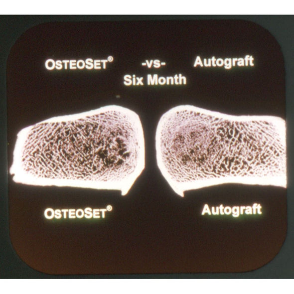 4 ANDREW - Wright Medical Technology, Inc. OsteoSet - View-Master Commercial Reel - vintage Reels 3dstereo 